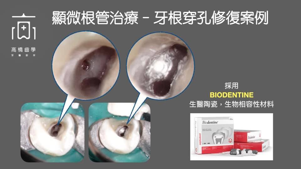 顯微根管治療-牙根穿孔修復案例
