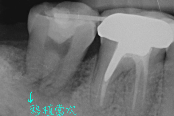 缺牙一定要植牙或做牙橋嗎？