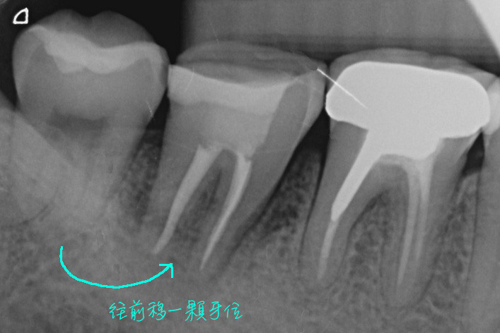 缺牙一定要植牙或做牙橋嗎？