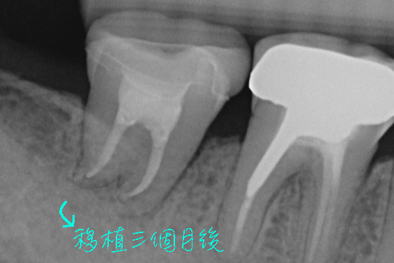 缺牙一定要植牙或做牙橋嗎？